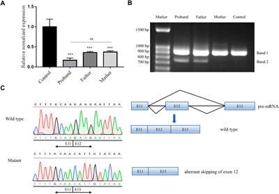 Two novel variants in CEP152 caused Seckel syndrome 5 in a Chinese family